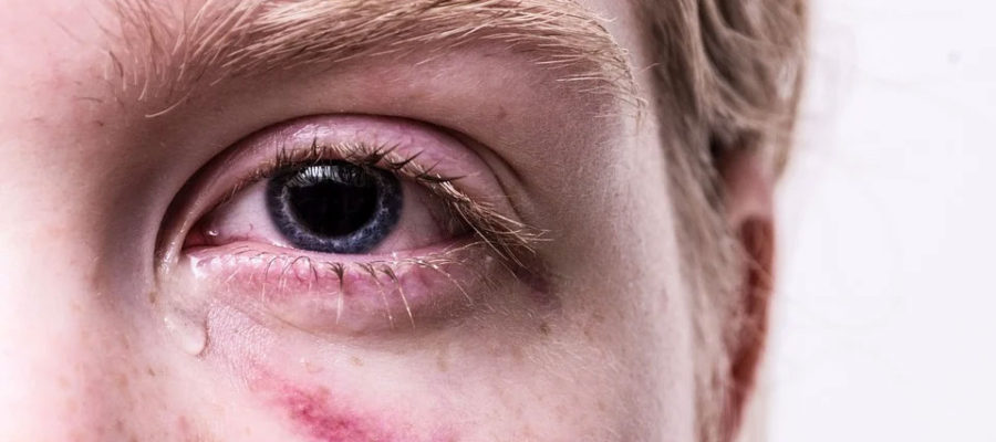 मौनसून के कारन आंखों का संक्रमण ज्यादा हो रहा है?